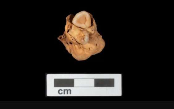 Найстаріша у світі. У давньоєгипетському похованні виявили рідкісну пухлину із зубами