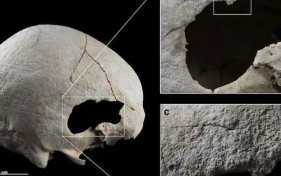 Рідкісне явище. В Іспанії знайшли скелет жінки, яка 4500 років тому пережила дві трепанації черепа